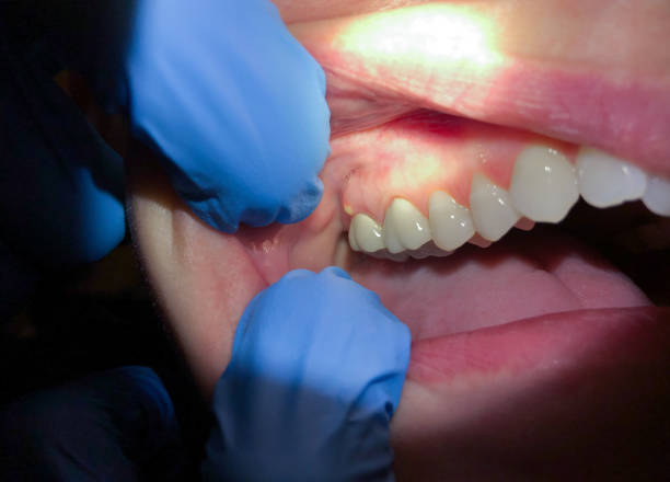 Best Emergency Broken Tooth Repair in Penhook, VA